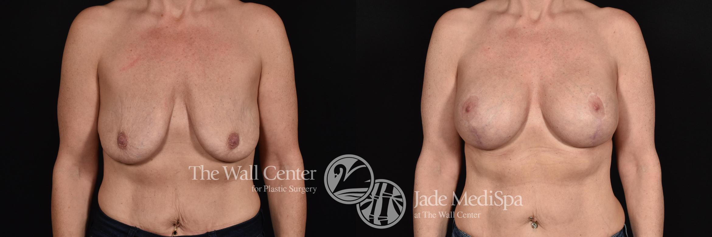 Before & After Breast Augmentation with Lift Case 604 View #1 View in Shreveport, LA