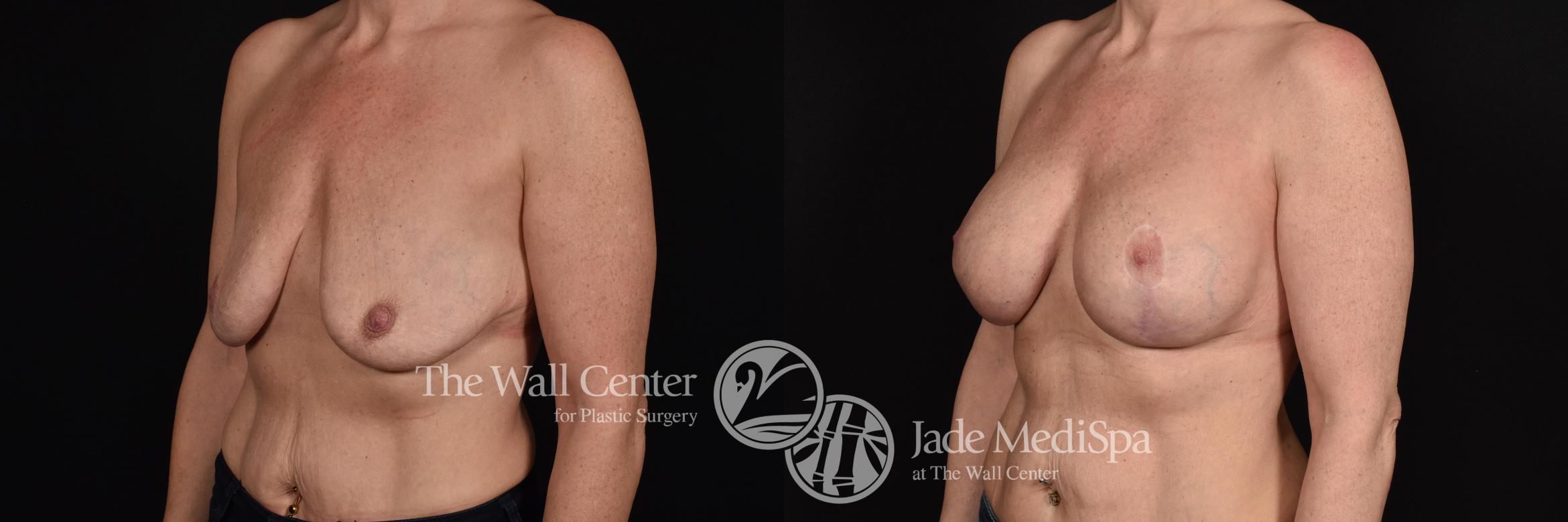 Before & After Breast Augmentation with Lift Case 604 View #2 View in Shreveport, LA