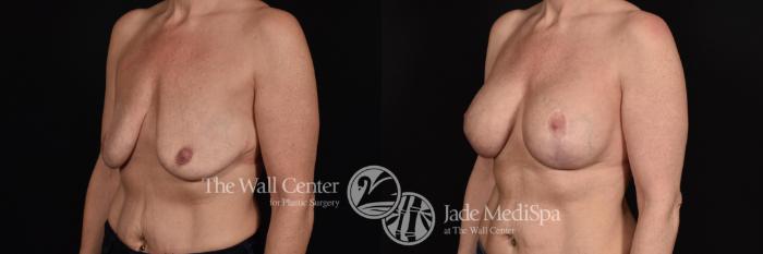 Before & After Breast Augmentation with Lift Case 604 View #2 View in Shreveport, LA