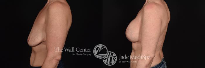 Before & After Breast Augmentation with Lift Case 604 View #3 View in Shreveport, LA
