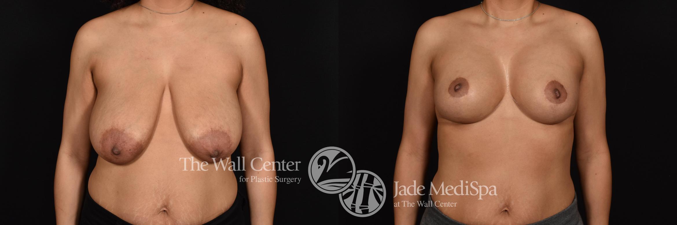 Before & After Breast Augmentation with Lift Case 634 VIEW #1 View in Shreveport, LA