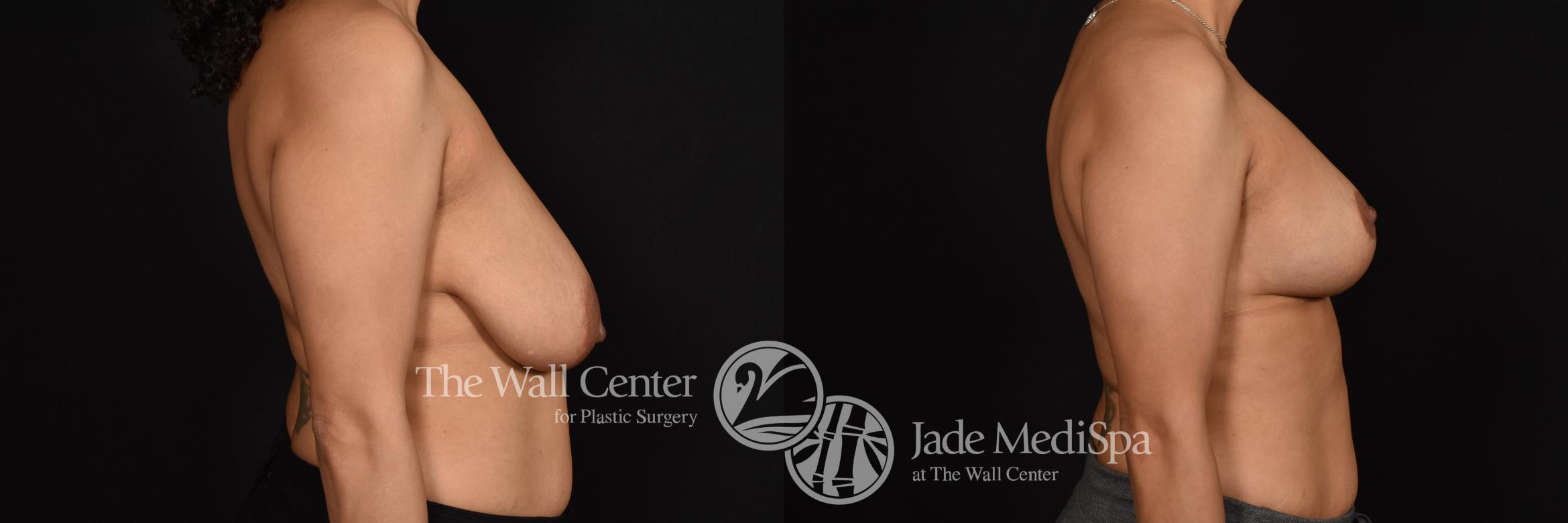 Before & After Breast Augmentation with Lift Case 634 VIEW #3 View in Shreveport, LA