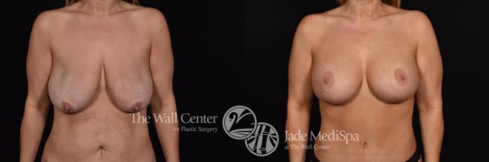 Before & After Breast Augmentation with Lift Case 637 VIEW #1 View in Shreveport, LA