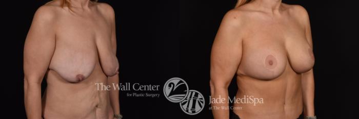 Before & After Breast Augmentation with Lift Case 637 VIEW #2 View in Shreveport, LA