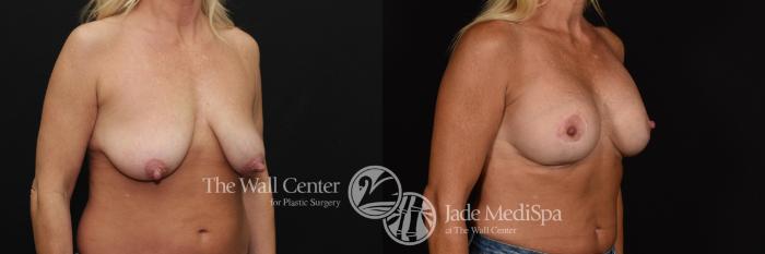 Before & After Breast Augmentation with Lift Case 642 VIEW #2 View in Shreveport, LA