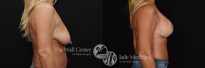 Before & After Breast Augmentation with Lift Case 642 VIEW #3 View in Shreveport, LA