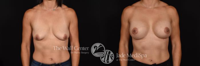 Before & After Breast Augmentation with Lift Case 644 VIEW #1 View in Shreveport, LA