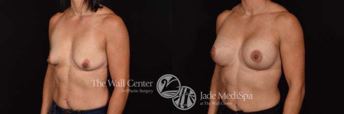 Before & After Breast Augmentation with Lift Case 644 VIEW #2 View in Shreveport, LA