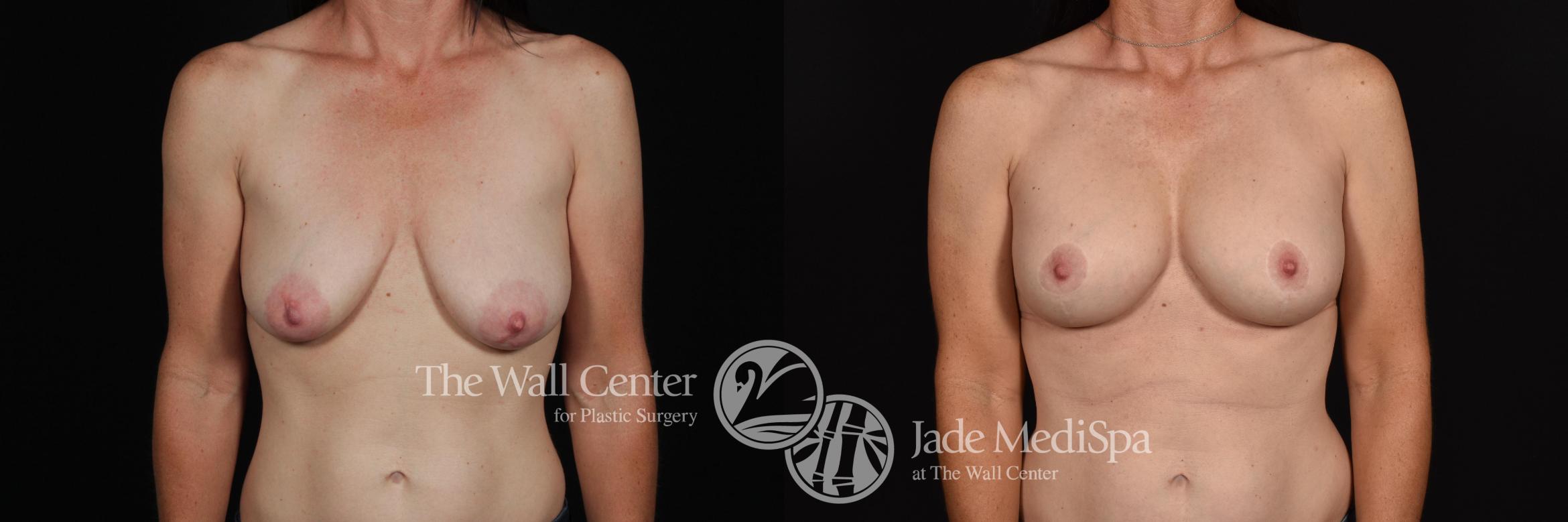 Before & After Breast Augmentation with Lift Case 646 VIEW #1 View in Shreveport, LA