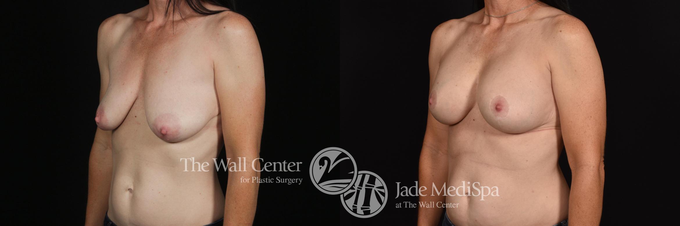 Before & After Breast Augmentation with Lift Case 646 VIEW #2 View in Shreveport, LA