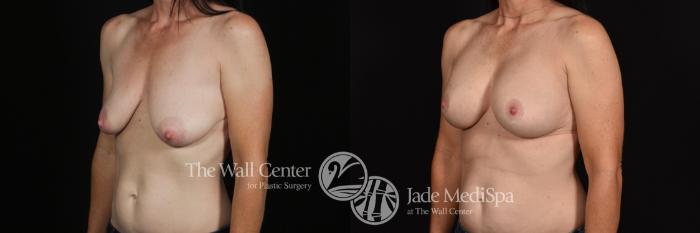Before & After Breast Augmentation with Lift Case 646 VIEW #2 View in Shreveport, LA