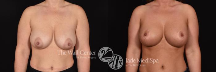 Before & After Breast Augmentation with Lift Case 668 VIEW #1 View in Shreveport, LA