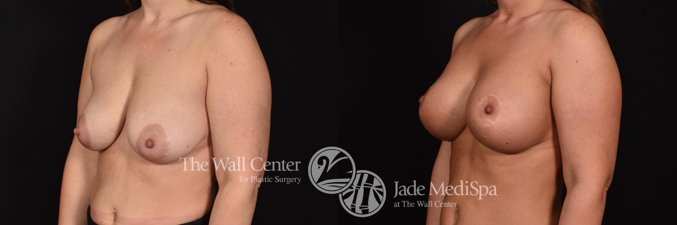 Before & After Breast Augmentation with Lift Case 668 VIEW #2 View in Shreveport, LA