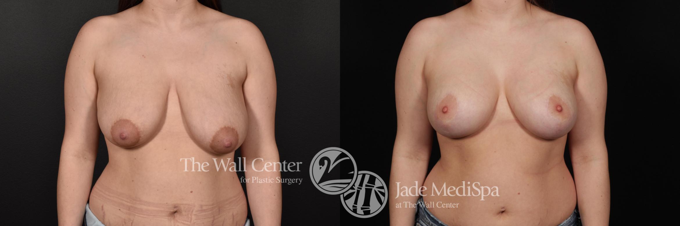 Before & After Breast Augmentation with Lift Case 669 VIEW #1 View in Shreveport, LA