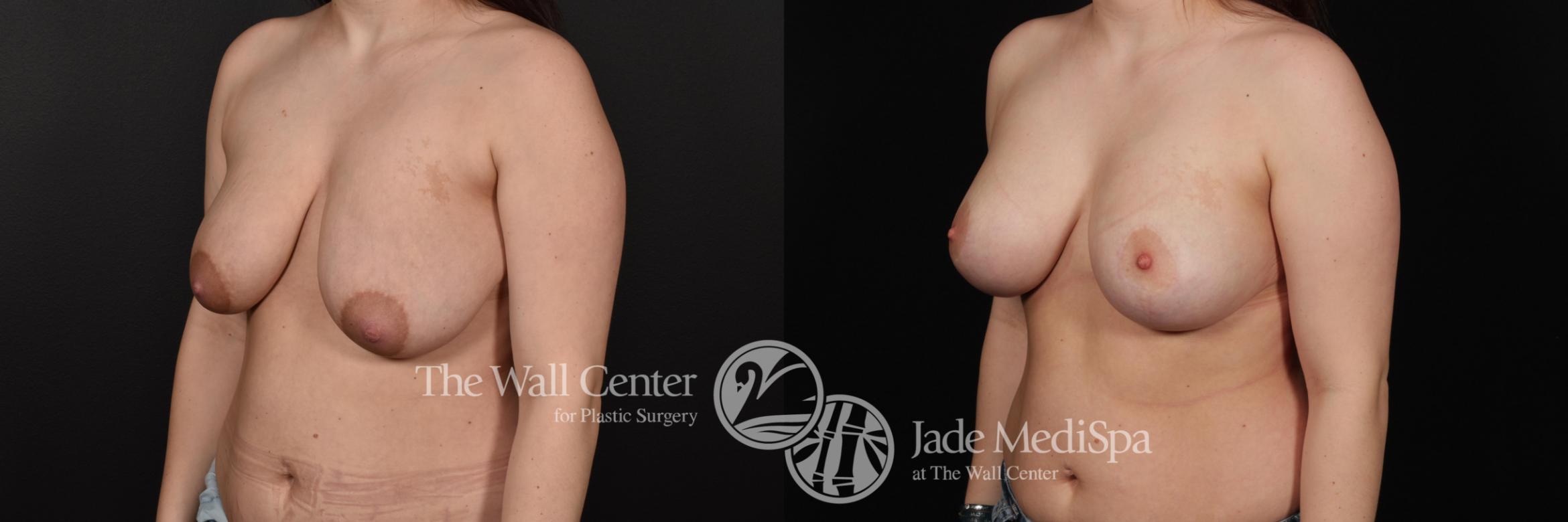 Before & After Breast Augmentation with Lift Case 669 VIEW #2 View in Shreveport, LA