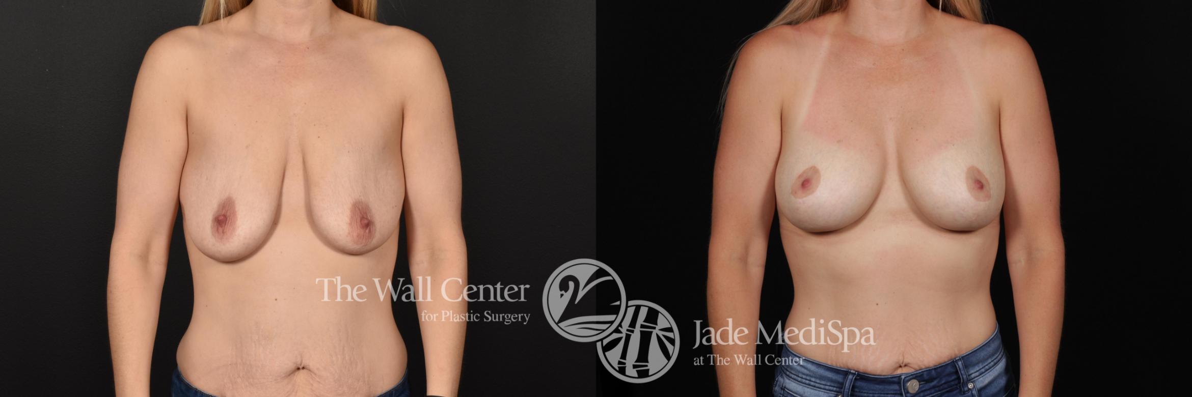 Before & After Breast Augmentation with Lift Case 670 VIEW #1 View in Shreveport, LA