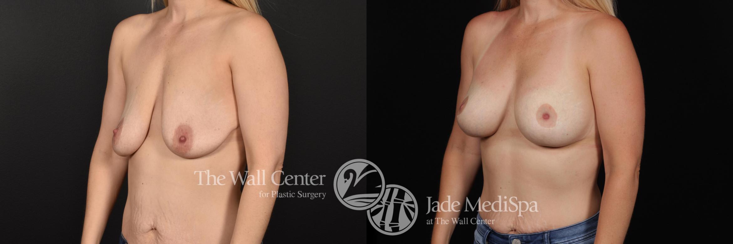 Before & After Breast Augmentation with Lift Case 670 VIEW #2 View in Shreveport, LA