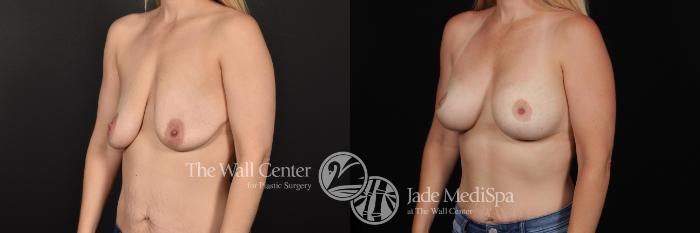 Before & After Breast Augmentation with Lift Case 670 VIEW #2 View in Shreveport, LA