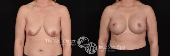 Before & After Breast Augmentation with Lift Case 671 VIEW #1 View in Shreveport, LA