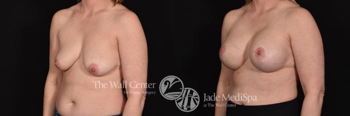 Before & After Breast Augmentation with Lift Case 671 VIEW #2 View in Shreveport, LA