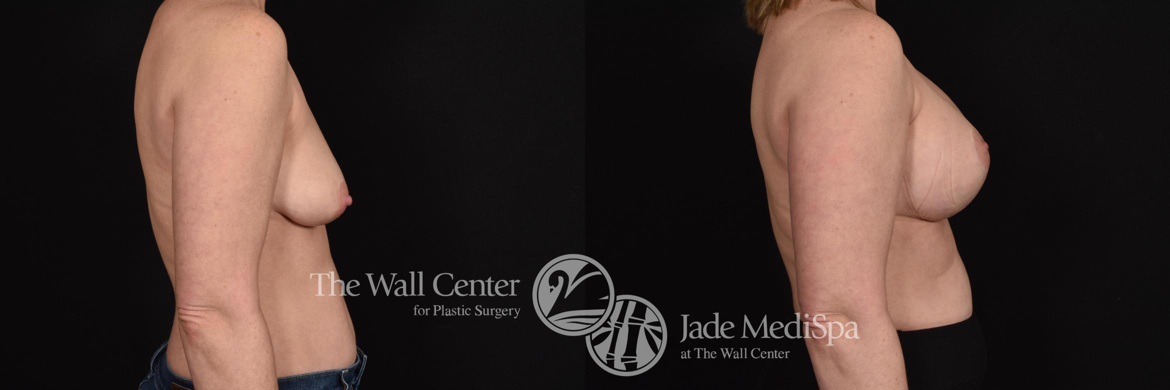 Before & After Breast Augmentation with Lift Case 671 VIEW #3 View in Shreveport, LA