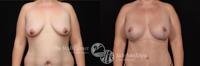 Before & After Breast Augmentation with Lift Case 688 VIEW #1 View in Shreveport, LA