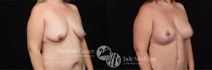 Before & After Breast Augmentation with Lift Case 688 VIEW #2 View in Shreveport, LA