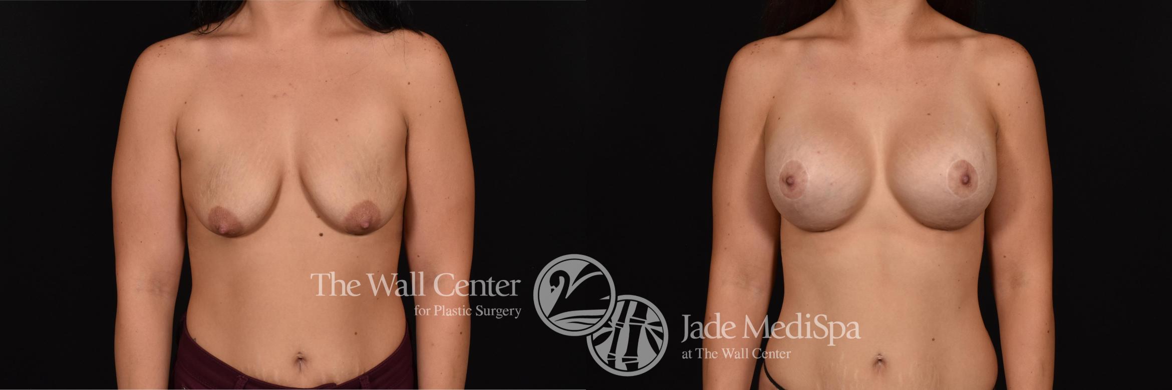 Before & After Breast Augmentation with Lift Case 689 VIEW #1 View in Shreveport, LA