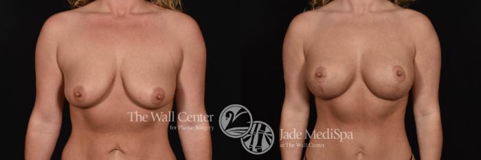 Before & After Breast Augmentation with Lift Case 690 VIEW #1 View in Shreveport, LA
