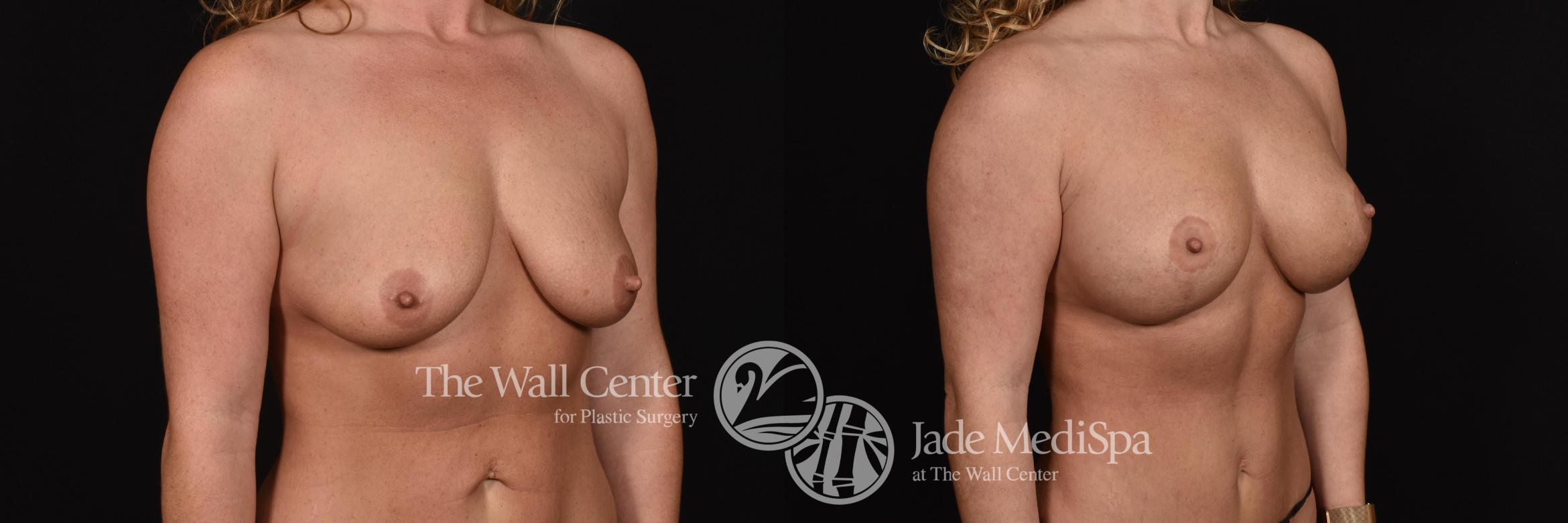 Before & After Breast Augmentation with Lift Case 690 VIEW #2 View in Shreveport, LA