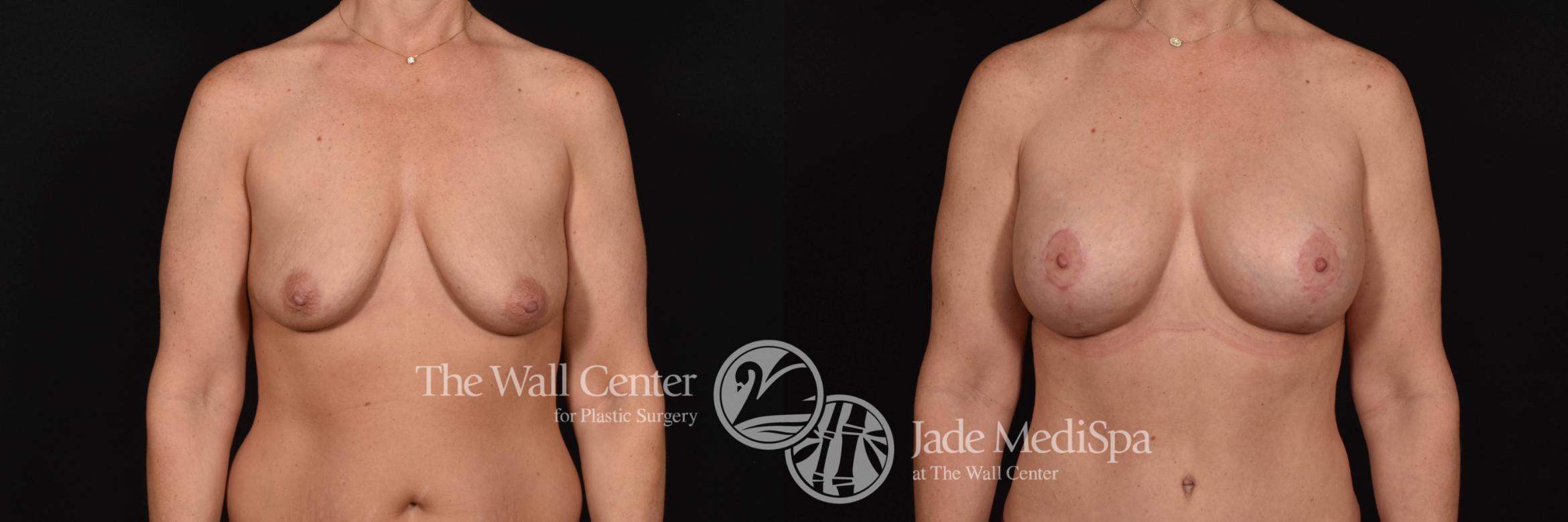Before & After Breast Augmentation with Lift Case 691 VIEW #1 View in Shreveport, LA