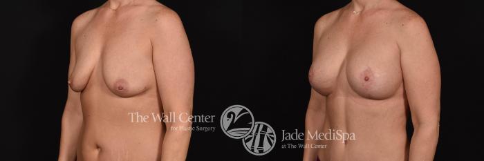 Before & After Breast Augmentation with Lift Case 691 VIEW #2 View in Shreveport, LA