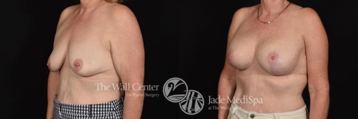 Before & After Breast Augmentation with Lift Case 693 VIEW #2 View in Shreveport, LA