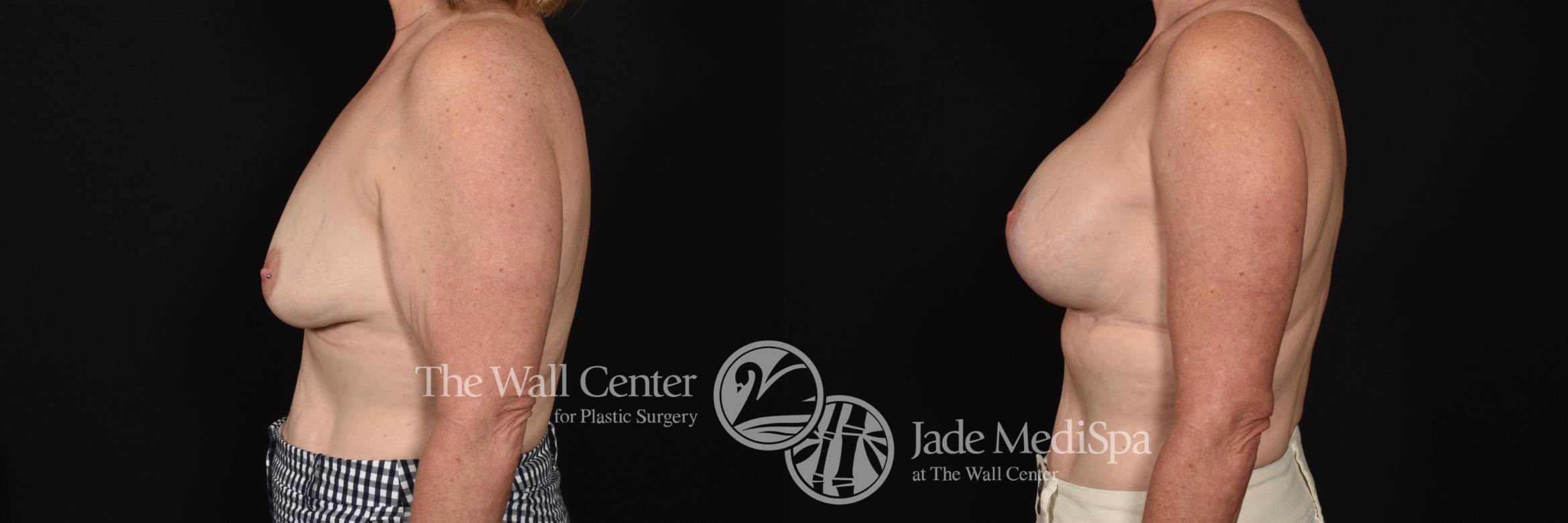 Before & After Breast Augmentation with Lift Case 693 VIEW #3 View in Shreveport, LA