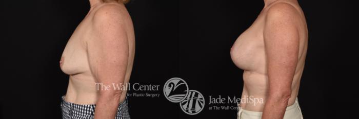 Before & After Breast Augmentation with Lift Case 693 VIEW #3 View in Shreveport, LA