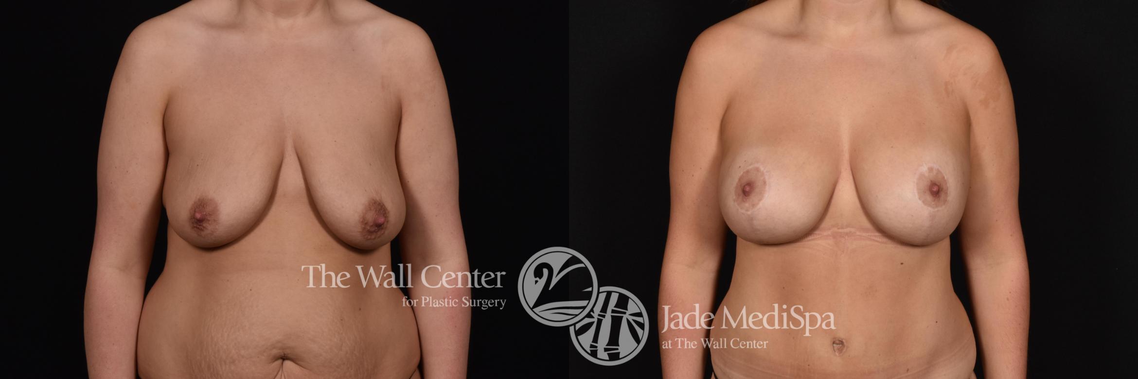 Before & After Breast Augmentation with Lift Case 702 VIEW #1 View in Shreveport, LA