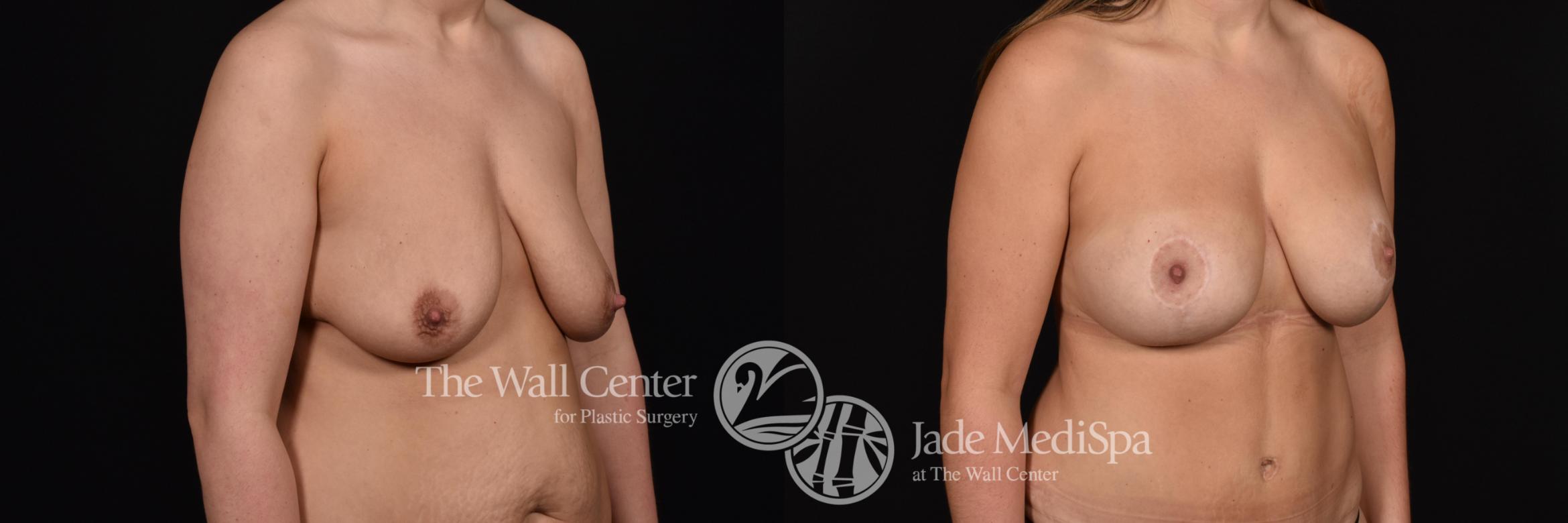 Before & After Breast Augmentation with Lift Case 702 VIEW #2 View in Shreveport, LA
