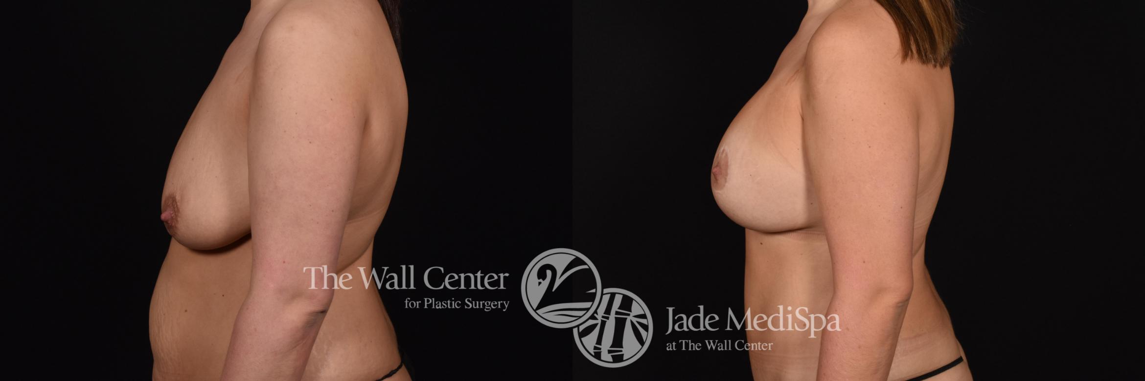 Before & After Breast Augmentation with Lift Case 702 VIEW #3 View in Shreveport, LA