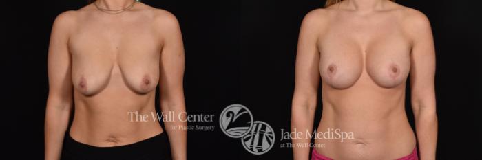 Before & After Breast Augmentation with Lift Case 730 VIEW #1 View in Shreveport, LA