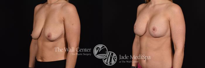 Before & After Breast Augmentation with Lift Case 730 VIEW #2 View in Shreveport, LA