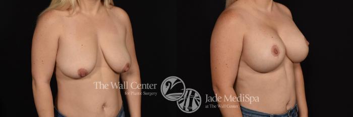 Before & After Breast Augmentation with Lift Case 773 VIEW #2 View in Shreveport, LA