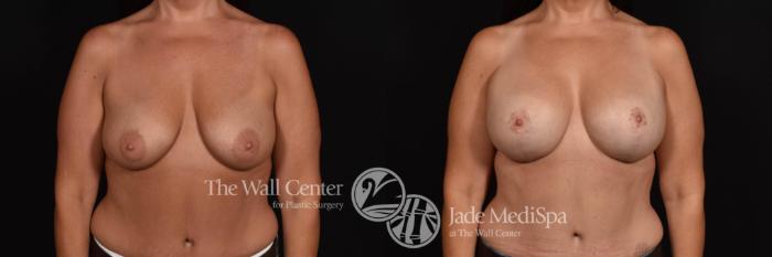 Before & After Breast Augmentation with Lift Case 796 VIEW #1 View in Shreveport, LA