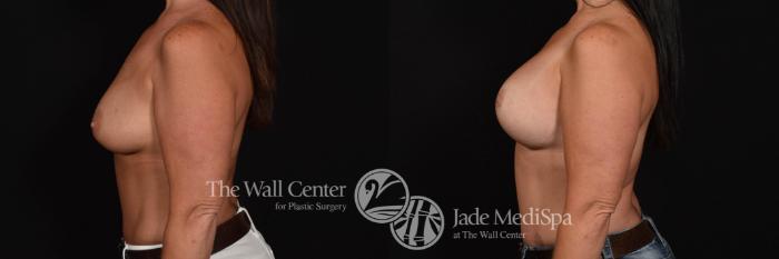 Before & After Breast Augmentation with Lift Case 796 VIEW #2 View in Shreveport, LA