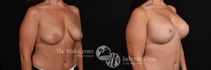 Before & After Breast Augmentation with Lift Case 796 VIEW #3 View in Shreveport, LA