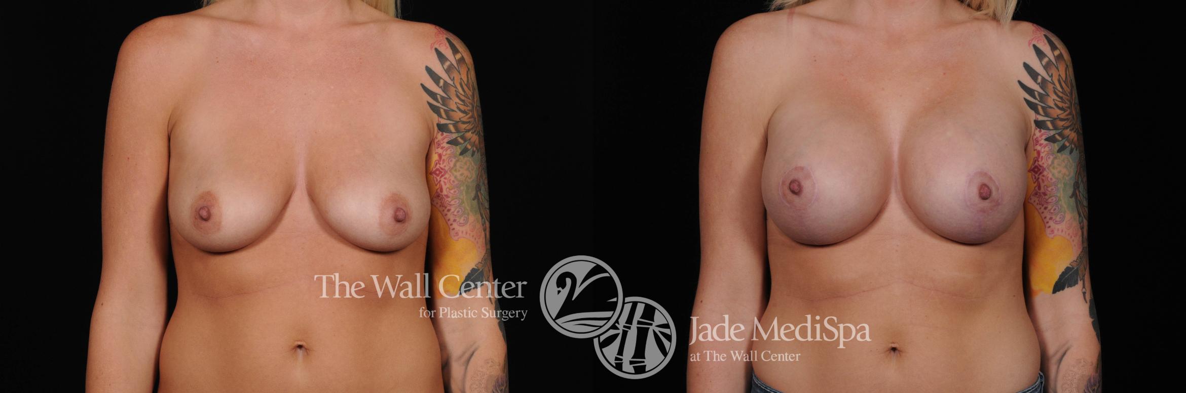 Breast Aug with Lift Front Photo, Shreveport, Louisiana, The Wall Center for Plastic Surgery, Case 808