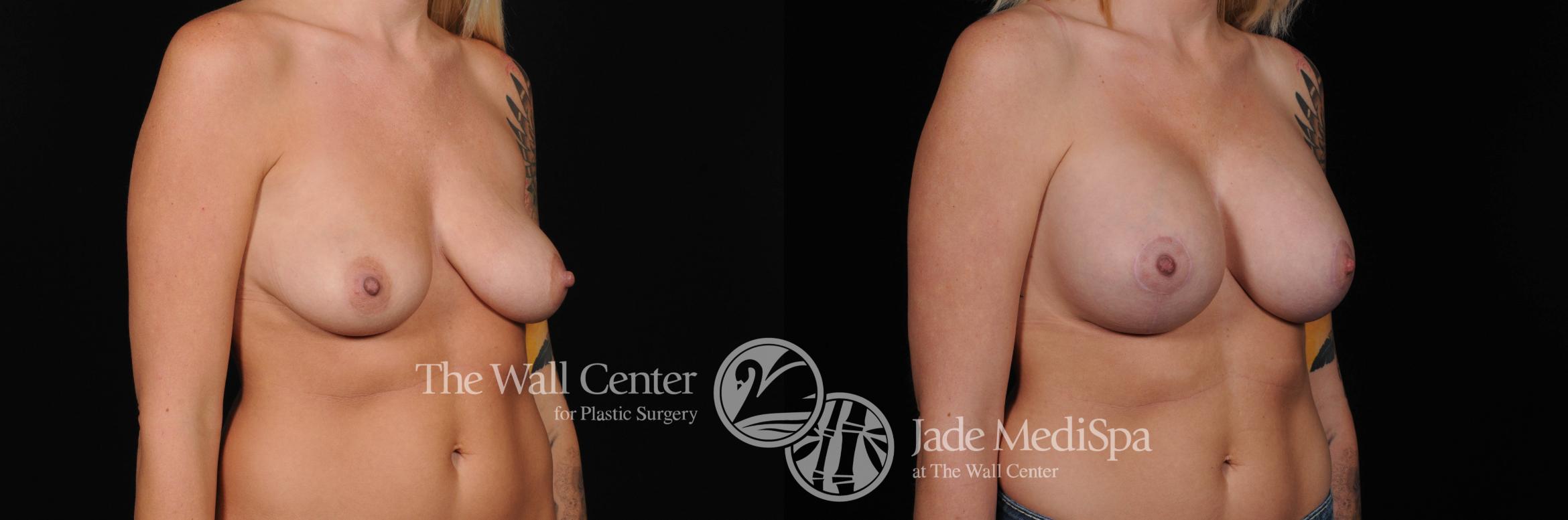 Breast Aug with Lift Right Oblique Photo, Shreveport, Louisiana, The Wall Center for Plastic Surgery, Case 808