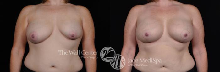 Breast Aug with Lift Front Photo, Shreveport, Louisiana, The Wall Center for Plastic Surgery, Case 811