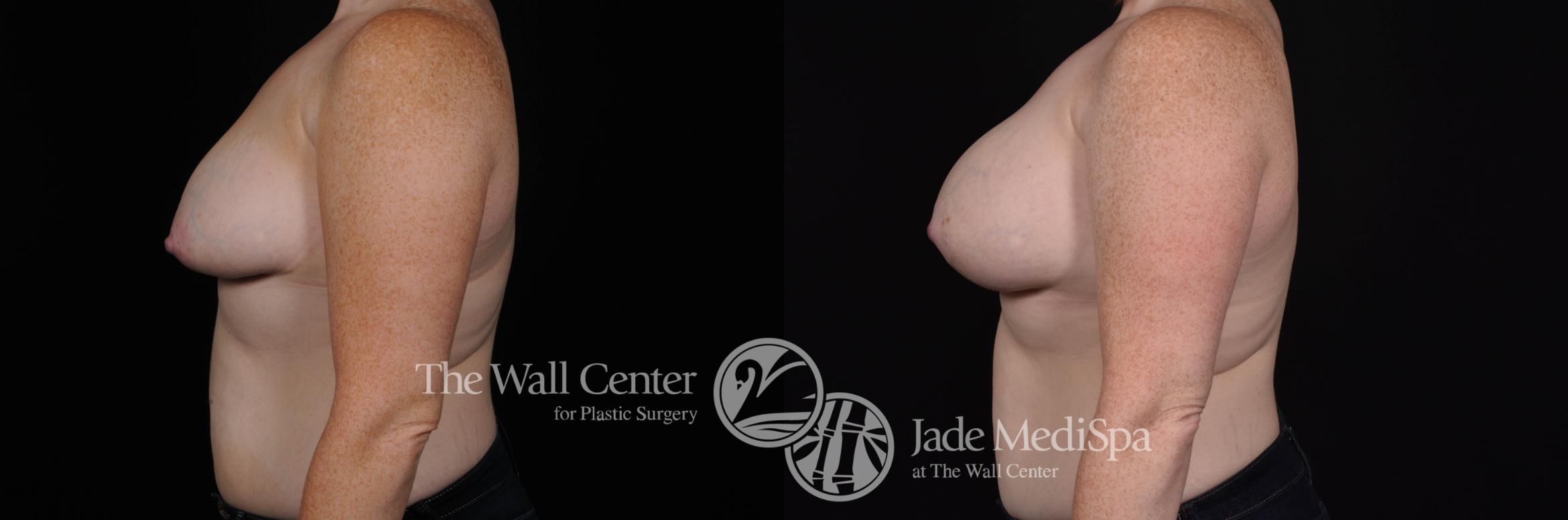 Breast Aug with Lift Left Side Photo, Shreveport, Louisiana, The Wall Center for Plastic Surgery, Case 811