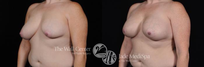 Breast Aug with Lift Left Oblique Photo, Shreveport, Louisiana, The Wall Center for Plastic Surgery, Case 811