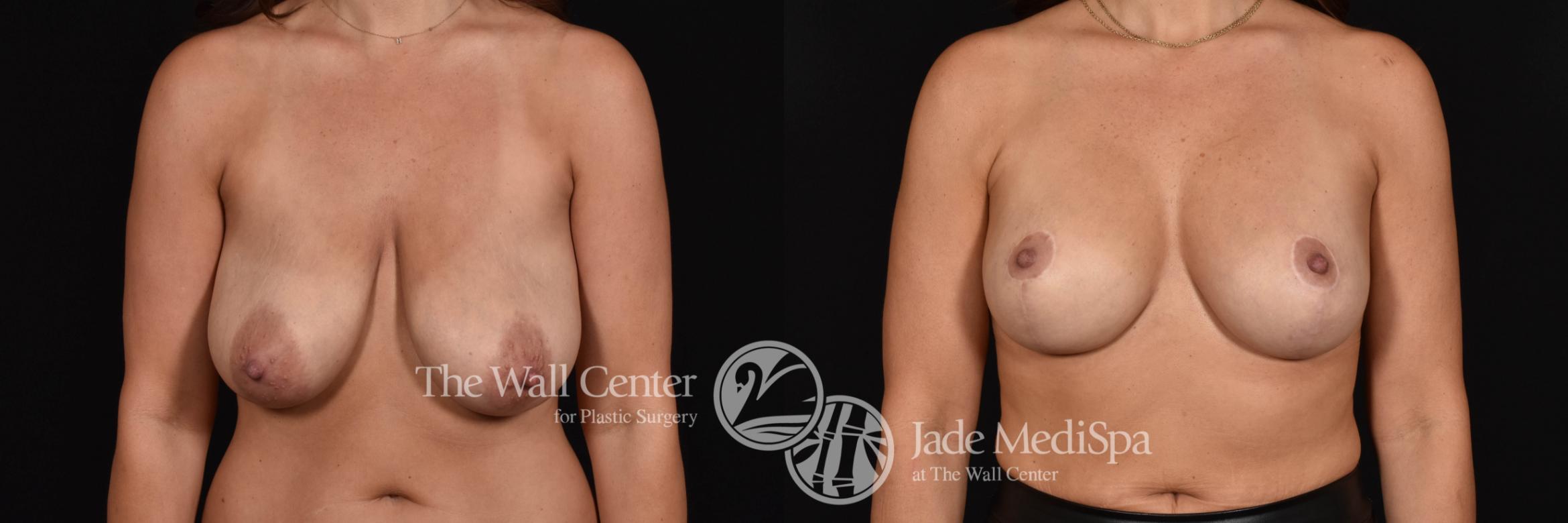 Breast Aug with Lift Front Photo, Shreveport, Louisiana, The Wall Center for Plastic Surgery, Case 830